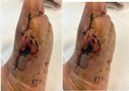 Case Study: Minimizing Scarring in Wound Healing