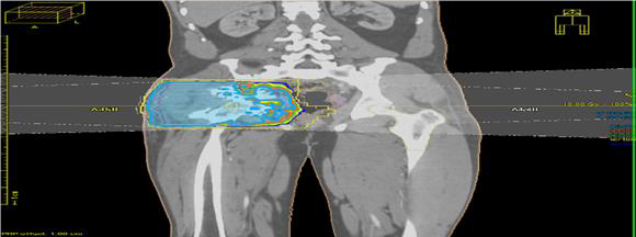 Radiation Therapy in Heterotopic Ossification: Case Series