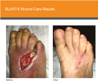 Case Study: Controlling the Wound Environment