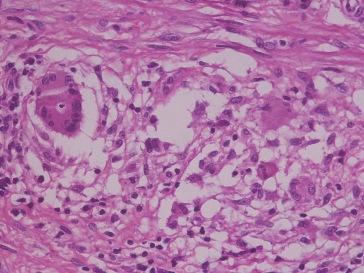 Tuberculosis Beyond the Lungs: A Rare Case of Rectal Stricture